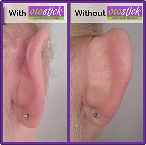 Otostick - TWIN PACK - Instant Correction for Prominent Ears, Transparent/Green, 4 count (Pack of 2) - Image 4