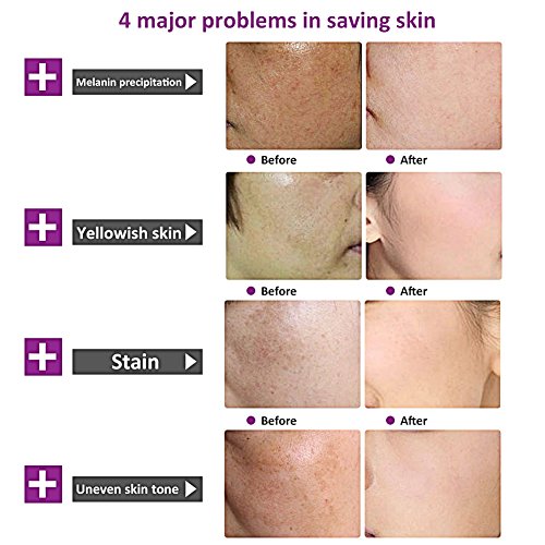 Skin Lightening Cream, Whitening Cream, Brightening Cream, Melasma Treatment Cream, Freckle Removal Cream For Face Brightening, Dark Spot, Skin Pigmentation, Age Spots For Face and Body - Thumbnail 7
