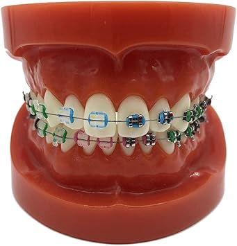 Amazon Co Jp 胴体心臓脳スケルトン医科大学教育歯科矯正デモンストレーションモデル 歯の教育モデル 金属ブラケットを使用した治療歯モデル ブラを使用したアーチワイヤー説明モデル スポーツ アウトドア