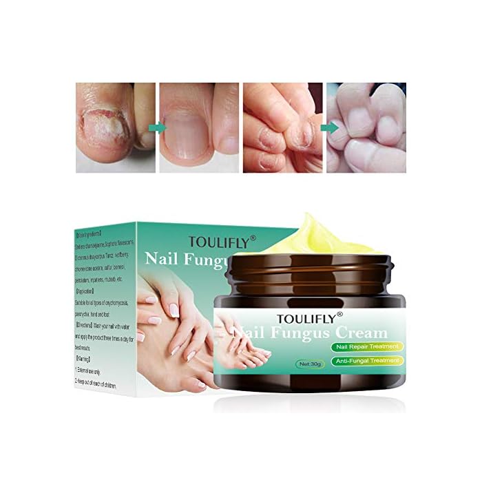 Nail Fungus Cream,Toenail Fungus Treatment,Nail Fungus Remover,Toenail Fingernail Fungus Remover Fungus Stop Cream