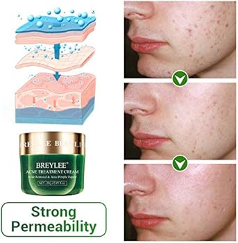 strong acne treatment