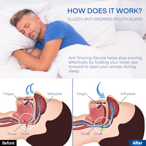 Anti Snoring Devices Mouth Guard: Snore Guard Anti-snoring Device - Snoring Solution- No Moldable and Easy to Fit (1 Count (Pack of 1))