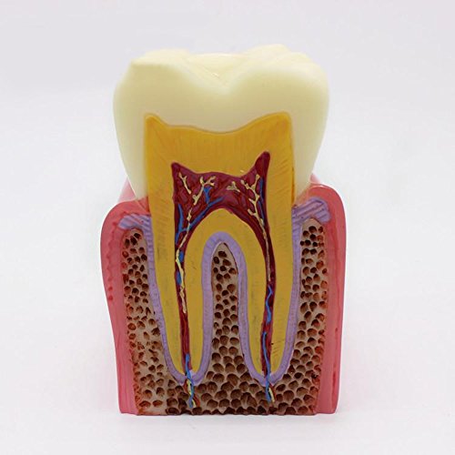 6 Times Caries Contrast Oral Model, Teeth Teaching Models for Research, Use for Patient Communication