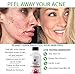 Planet Eden 30% Salicylic Acid Skin Chemical Peel Kit + Glycolic Acid Pre-Peel Cleanser + Antioxidant Recovery Cream Moisturizer - Strong Kit to eliminate acne, blackheads, dark spots, enlarged pores