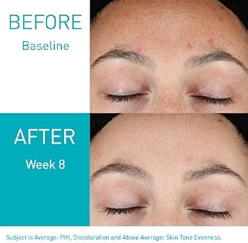 retinol good for acne scars