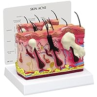 Skin Acne Anatomical Model Normal/Acne Cross-Section