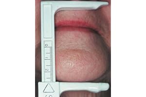 LEEMARK Knebelman Craniometer