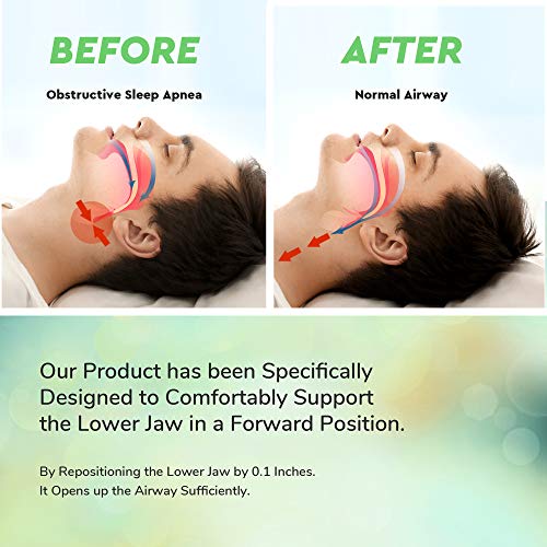 Snore Stopper Mouth Guards for Teeth Grinding, Sleep Aid Custom Fit Night Mouthpiece, Anti Snoring Solution with Case
