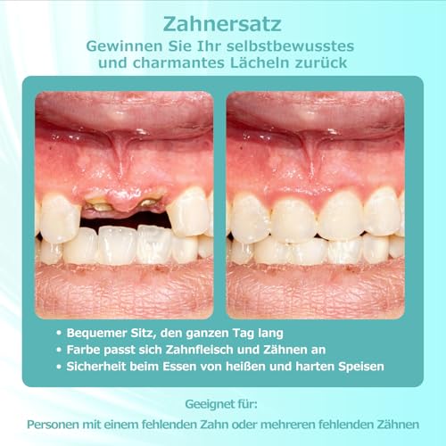 Custom Partial Denture for Dental Spaces - Removable Provisional Denture for Men & Women, Dentures with Perfect Fit Easy to Use for a Perfect Smile (2 Teeth)