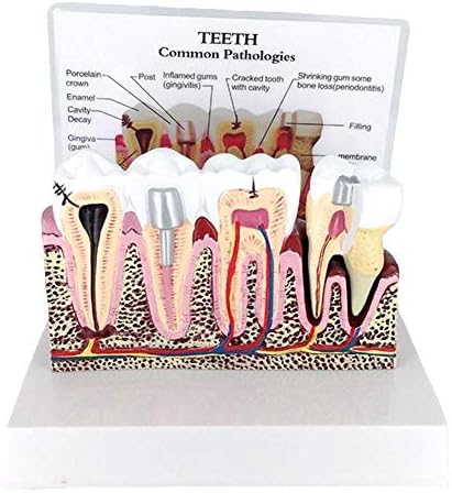 Dental Anatomy of Dental Caries Teeth Model Demonstration