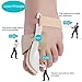 Bunion Corrector, HAV Splint Day and Night Splint Hammer Toe Corrector, 2pcs Adjustable Velcro Bunion Splint Protector Sleeves kit (Nude)