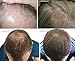 HairMax Prima 9 LaserComb (FDA Cleared). Hair Growth Device. Reverses Thinning, Regrows Denser, Fuller Hair. Targeted Hair Loss Treatment. 9 Medical Grade Lasers.