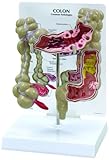 Colon Human Anatomical Model with Pathologies