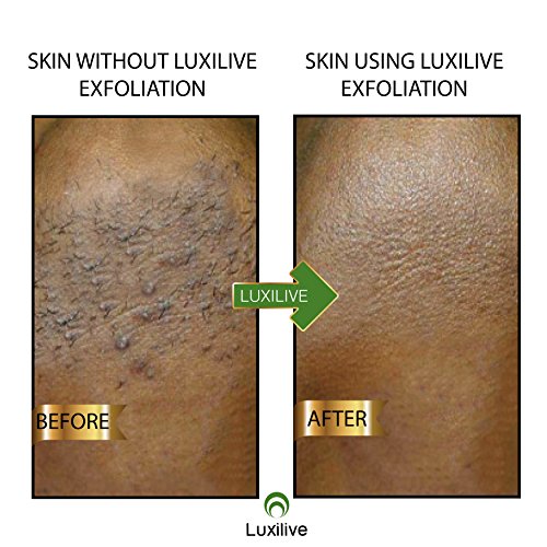 Luxilive Exfoliator Brush Ingrown Hair Stainless Steel Tweezer
