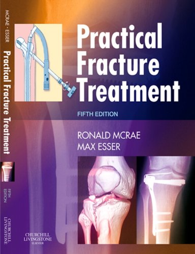 Practical Fracture Treatment E-Book