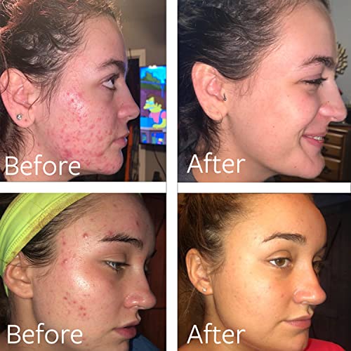 Dr Song Benzoyl Peroxide Wash 10 with Hyaluronic Acid Acne Treatment