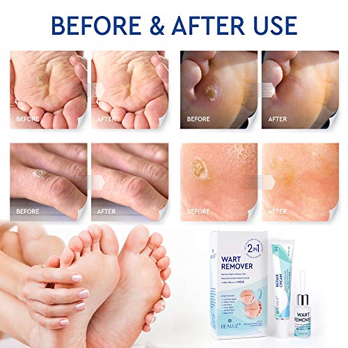 Natural Liquid Wart Remover by BEALUZ Maximum Strength, Easy & Quick Results for Plantar