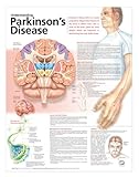 Understanding Parkinson's Disease Anatomical Chart