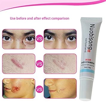 bleaching cream for stretch marks