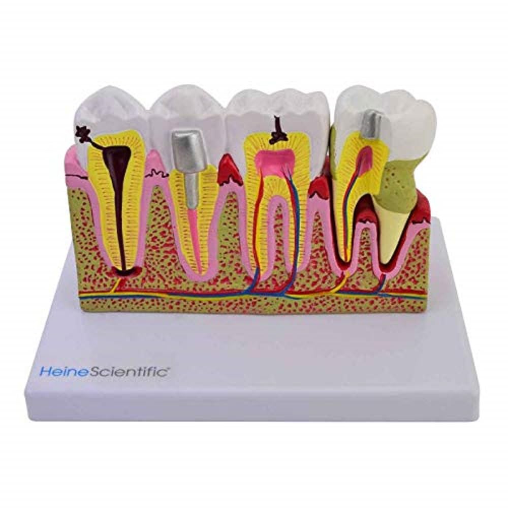 HeineScientific 2-Piece Model of Dental Damage and Sicks