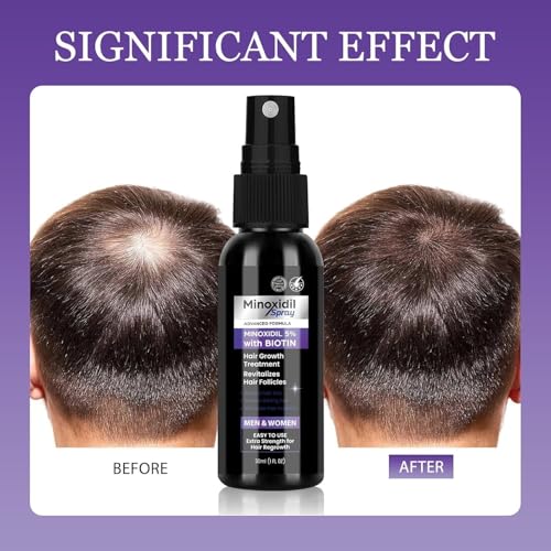 KALEDE 5% Minoxidil Spray for Men Women, 2 pcs 30ml Minoxidil for Women Hair Growth, Minoxidil for Men Hair and Beard Growth Spray，Hair Loss Serum for Hair Growth and Beard Restoration