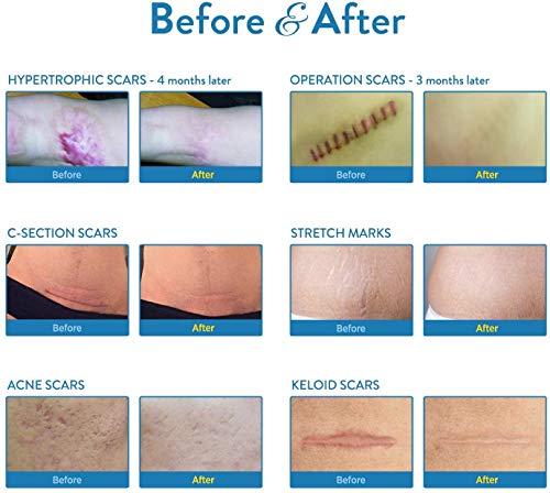 Aroamas Professional Silicone C-Section Scar Removal Sheets, Soft Adhesive Fabric Strips, Drug-Free, Relieves Itching, Remove Keloid Scars, Acne. 5.9" ✕ 1.6", 4 pcs (2 Month Supply), Beige