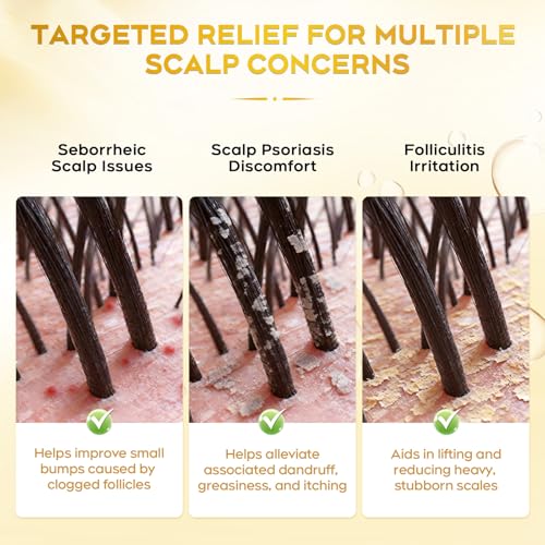 oely Enhanced Antifungal Shampoo for Seborrheic Dermatitis, Folliculitis & Scalp Psoriasis – Anti-Dandruff Shampoo for Men & Women, Relieves Itchy Dry Scalp, Sulfate & Paraben-Free, 10.1 Fl Oz-Fresh
