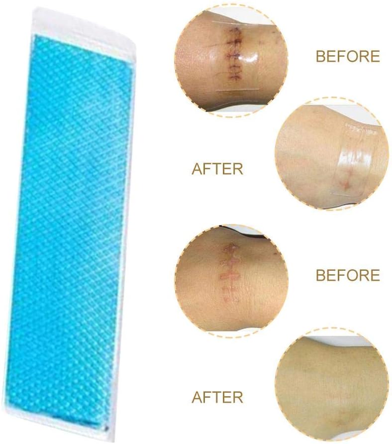 rimozione della cheloide