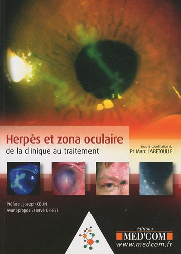 Herpès et zona oculaire
