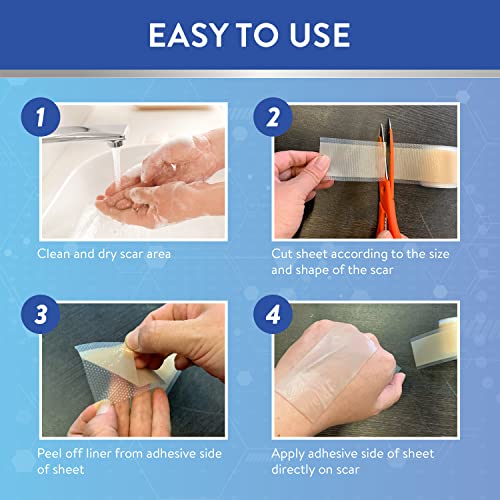 Aroamas Scar Silicone Scar Sheets Silicone Scar Tape 1.6x60 for