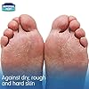 Urea-Cream-for-Cracked-Heels-Dry-Skin-Hand-Cream-Diabetic-Foot-Cream-Callus-Hard-Skin-XL-150-ML Imperial Feet Urea Foot Balm - Natural Urea Cream for Rough & Dry Skin, Calluses - Cracked Heel Treatment with Cleansing…