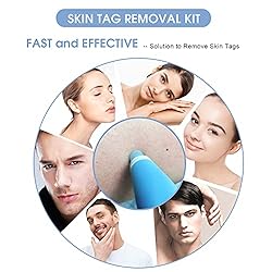Skin Tag Remover, Skin Tag Removal Kit Tools with