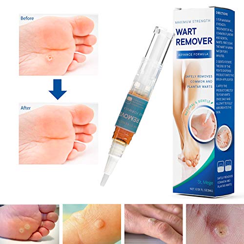 ST. Mege Wart Pen - Maximum Strength - Wart Pen for Flat Warts, Plantar Warts, Common Warts - Corn, Callus - Lightweight - Easy-to-Use - Travel-Friendly
