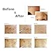 Blackhead Acne Remover Kit, Aooher 9pcs Stainless Steel Blemish and Comedones Extractor Tool Set for Treating Blackhead Whitehead Acne Pimples