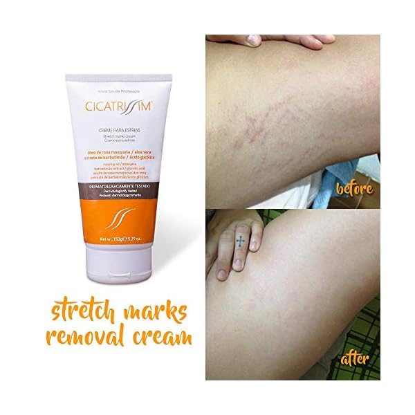 Cicatrissim Stretch Marks Removal Cream - Innovative Natural Formula With Pure and Potent Ingredients From Brazilian…
