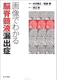 画像でわかる脳脊髄液漏出症