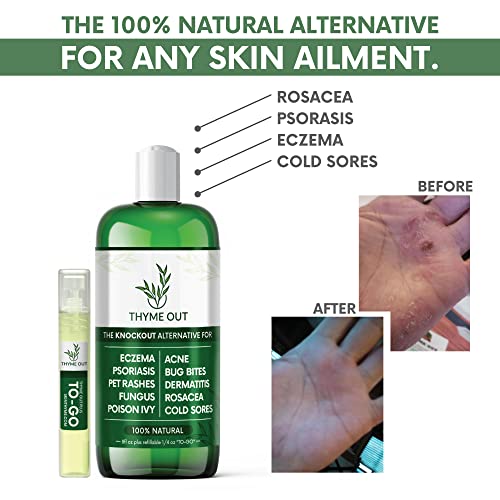 All Natural Eczema Treatment Psoriasis Treatment An AllinOne