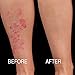 Psoriasis Cream. Psocleer Advanced Formula with 2% Salicylic Acid for Relief of Flaking, Scaling, Itching and Dry Skin 4oz.