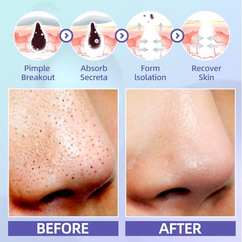 10 Pack Nose Strips Hydrocolloid Blackhead Remover Deep Cleansing & Pore Shrinkage Oil Control Acne Blackhead Remover Soft Skin Care for Everything