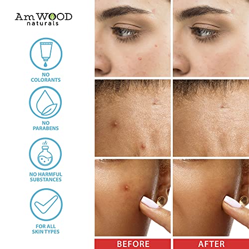 Acne Patches Hydrocolloid Bandages with Salicylic & Hyaluronic Acids