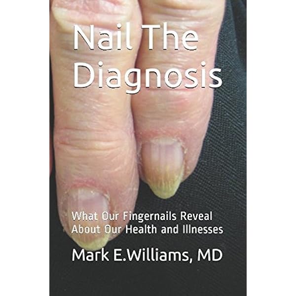 Nail The Diagnosis What Our Fingernails Reveal About Our Health And Illnesses Williams Md Mark E Amazon Com Books