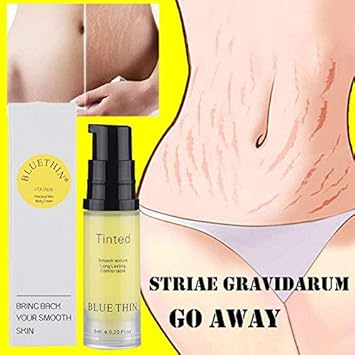 fat stretch marks removal cream