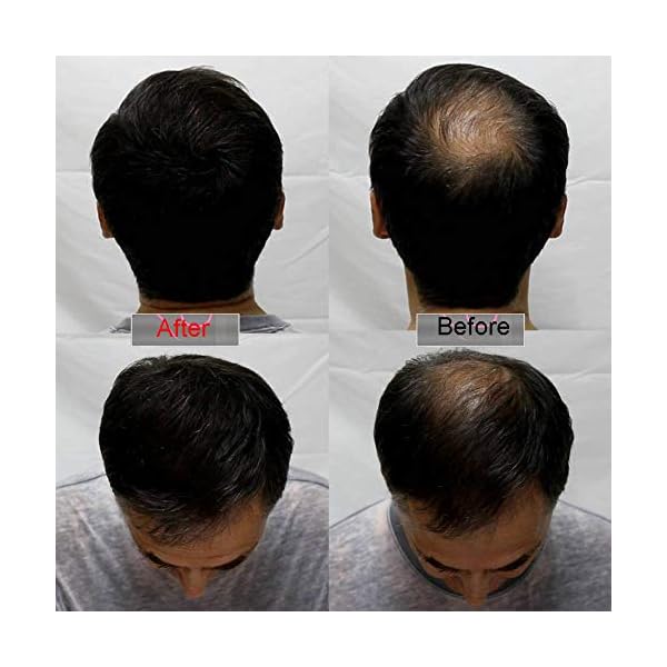 SEVICH-Keratin-Hair-Building-Fibers-5-Seconds-Conceals-Loss-Hair-Rebuilding-Nature-Concealer-Fibers-for-Thinning-Hair-25g-Medium-Brown SEVICH Keratin Hair Building Fibers - 5 Seconds Conceals Loss Hair Rebuilding, Nature Concealer Fibers for Thinning Hair…