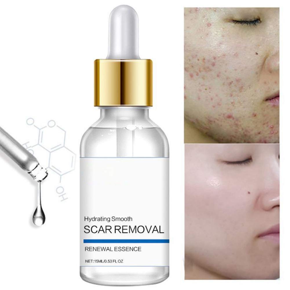 acne scar removal cream amazon