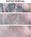 TCA 50% Tattoo removal, Skin tags, Warts, Age Spots, Freckles (1/2 oz) (15ml) by RePare Skincare