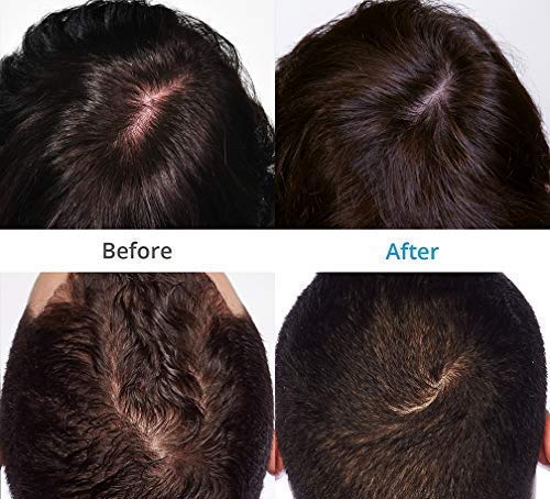 Theradome Evo Lh40 Medical Grade Laser Hair Growth Helmet Fda