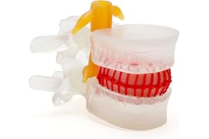 RONTEN Human Lumbar Disc Herniation Model, Transparent Lumbar Spine Model, with Elastic Software, Press to Simulate Lumbar Disc Herniation