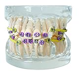 Dental Orthodontic Treatment Study Model with Purple Brackets and Yellow Elastic O-Rings