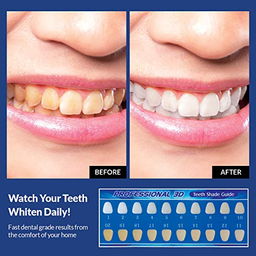 Premium Teeth Whitening Kit, LED Light, 35% Carbamide Peroxide, Safe & Natural At-Home System Without Pain or Sensitivity, Effectively Removes Stains for Whiter Teeth