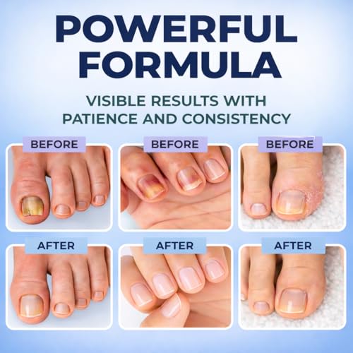 Athlete‘s Foot & Toenail Fungus Treatment Pen – Extra Strength Antifungal with 25% Undecylenic Acid, Maximum OTC, Precision Applicator for Itch Relief & Nail Care, Between Toes, 3 Pens + 5 Files